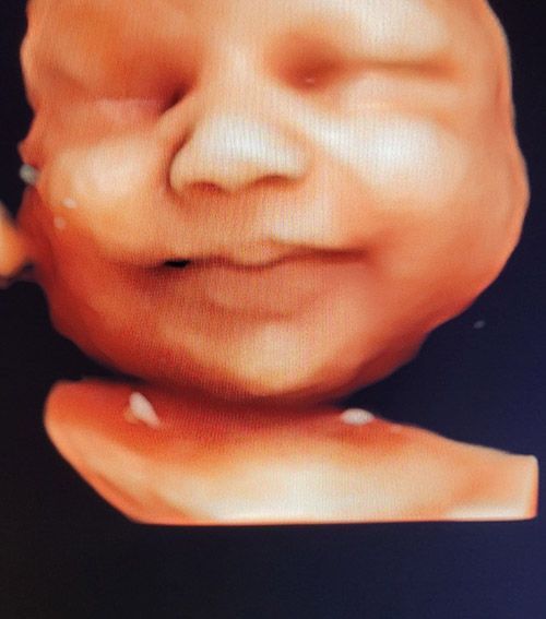 1st Month Baby Ultrasound — Middletown, NY — LAFS Ultrasound