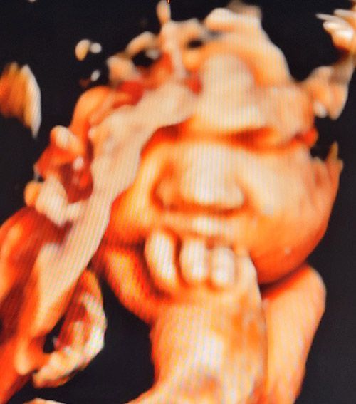 Baby Ultrasound — Middletown, NY — LAFS Ultrasound