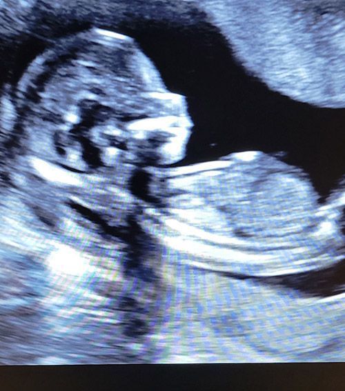 4th Month Baby Ultrasound — Middletown, NY — LAFS Ultrasound
