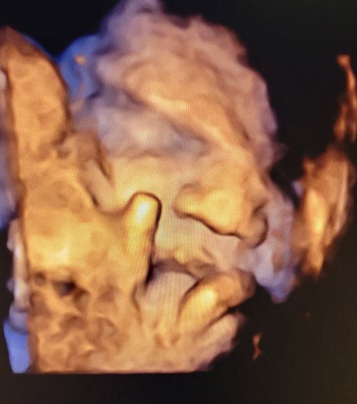 9th Month Baby Ultrasound — Middletown, NY — LAFS Ultrasound