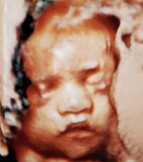 3rd Month Baby Ultrasound — Middletown, NY — LAFS Ultrasound