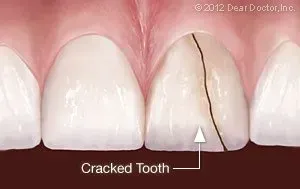 Cracked Tooth — Homer, AK — Preventive Dentistry Services