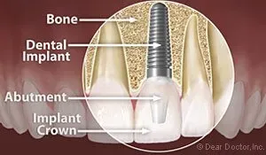 Dental Implant — Homer, AK — Preventive Dentistry Services