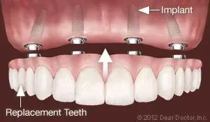 Replacing Teeth — Homer, AK — Preventive Dentistry Services
