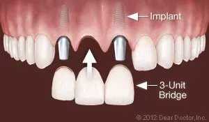 3-Unit Bridge — Homer, AK — Preventive Dentistry Services