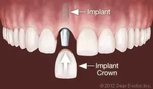 Implant Crown — Homer, AK — Preventive Dentistry Services
