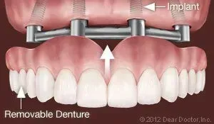 Removable Denture — Homer, AK — Preventive Dentistry Services