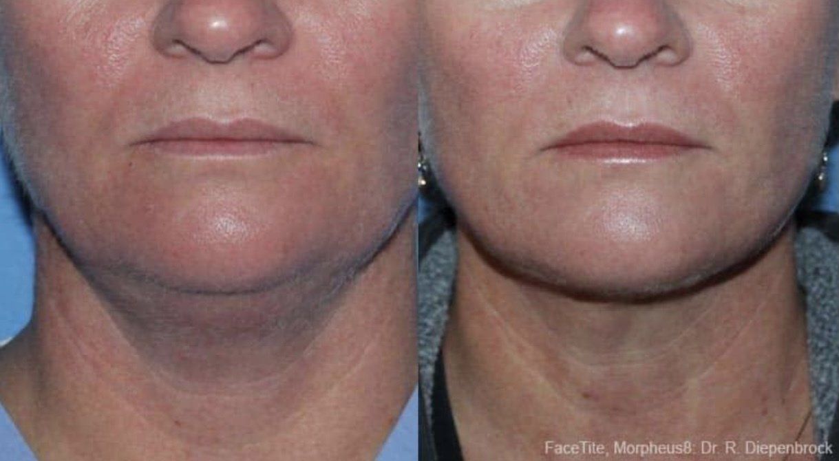 Résultat du morpheus 8 à Genève - lifting non chirurgical - Resurfacing cutanée - Traitement des vergetures à Genève - Traitement des cicatrices à Genève - Traitement anti-âge non chirurgical