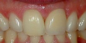 Close up of teeth After Crowns