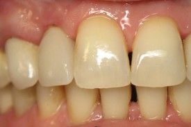 close up of teeth after dental implant.