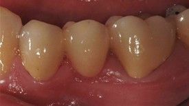 close up of teeth with a porcelain fixed bridge.