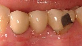 Close up of teeth Before Fixed Bridges
