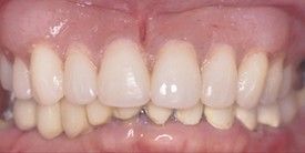 Close up of teeth After Dentures