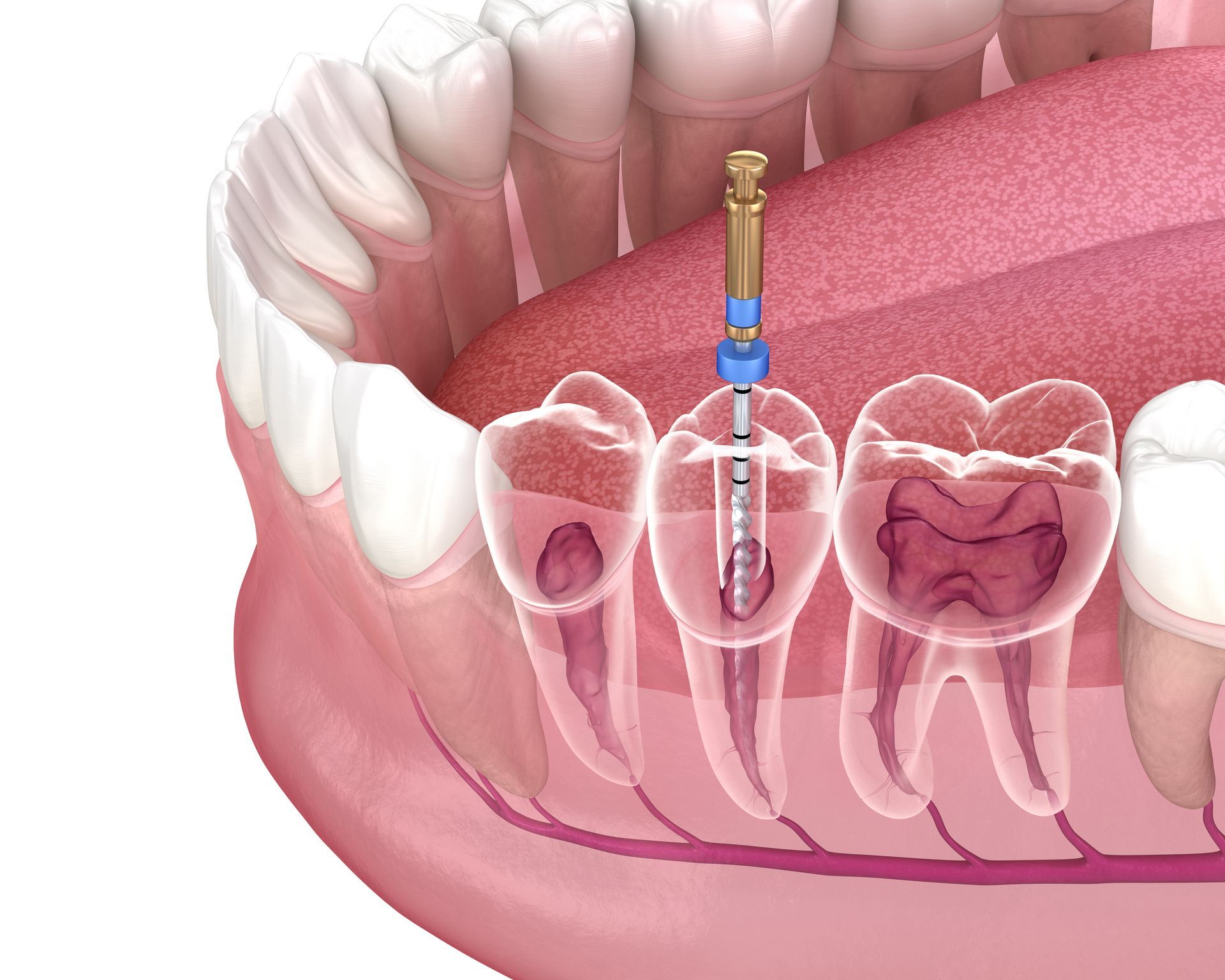 3d image of root canal procedure