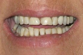 Close up of teeth Before Porcelain Crowns