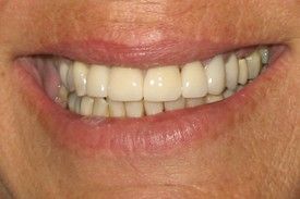 Close up of teeth After Porcelain Crowns
