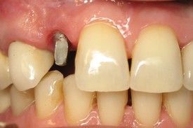 Close up of teeth Before Dental Implants