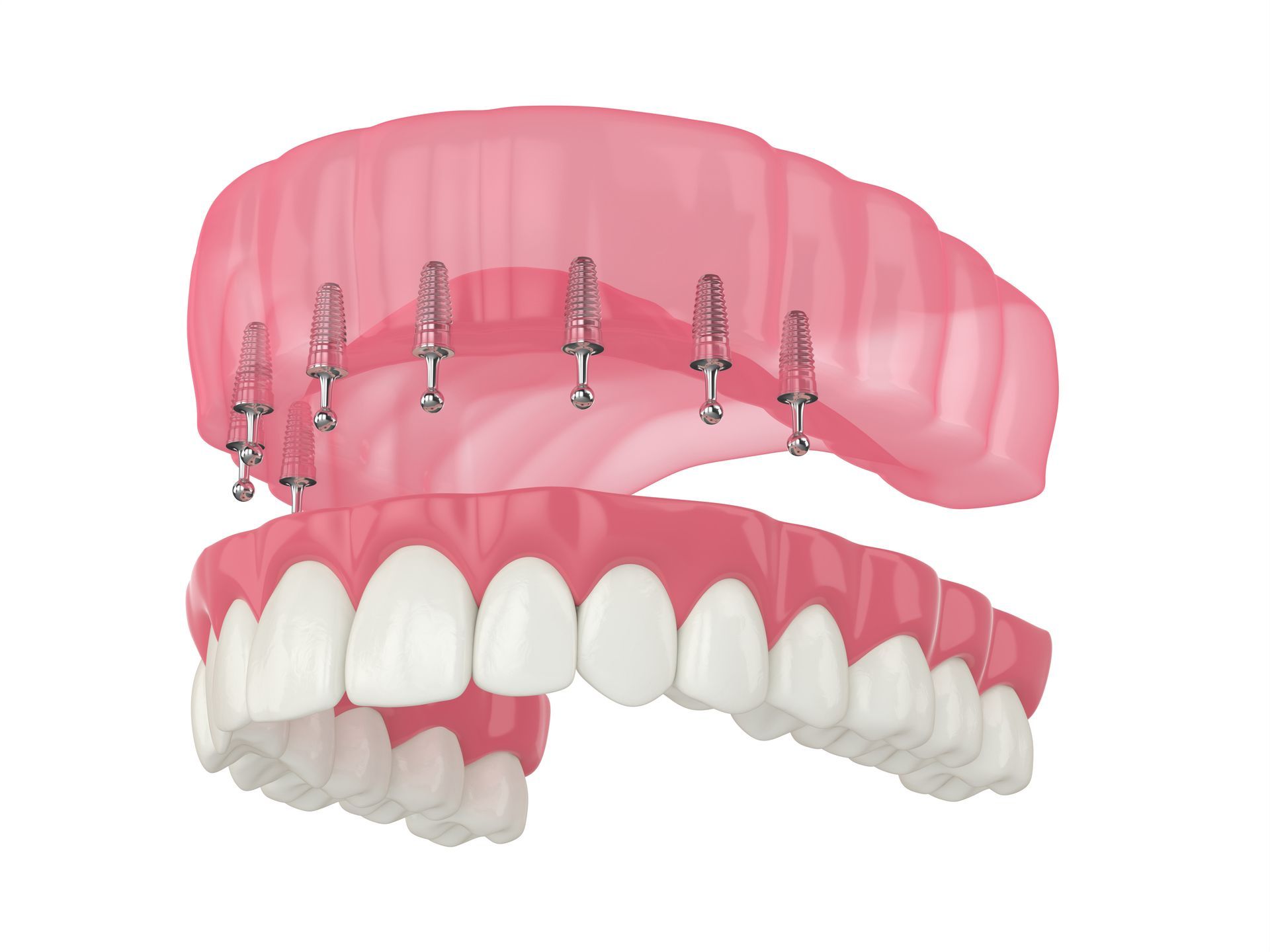 3d image of snap in dentures