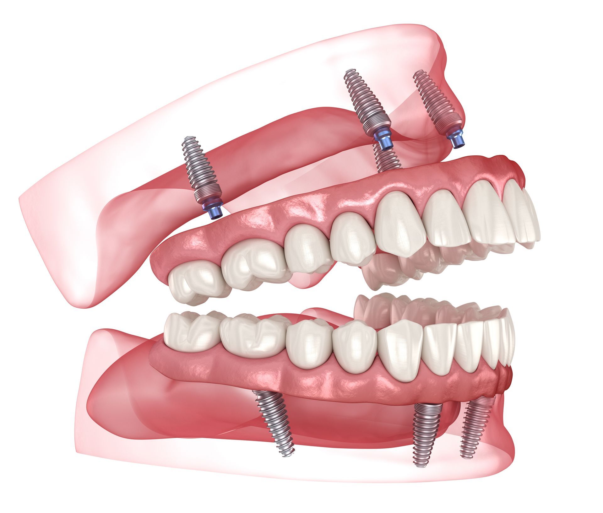 3d image of complete dentures