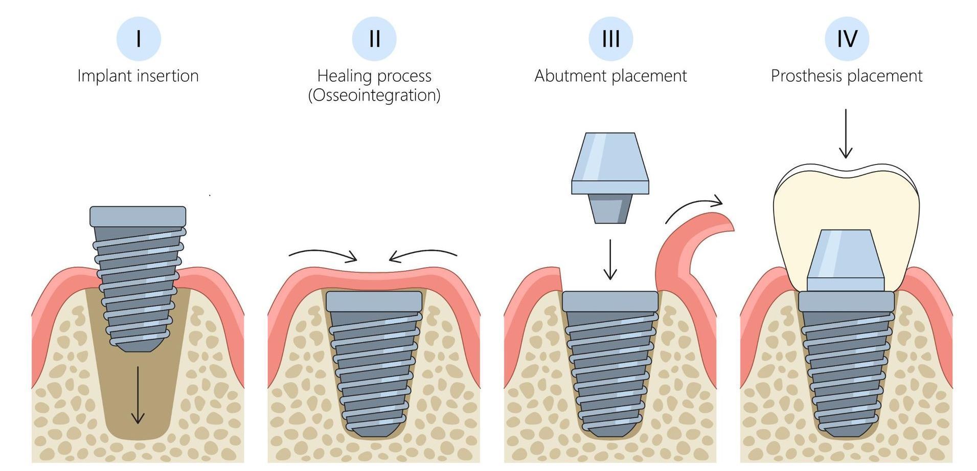 A diagram showing the steps of dental implantation