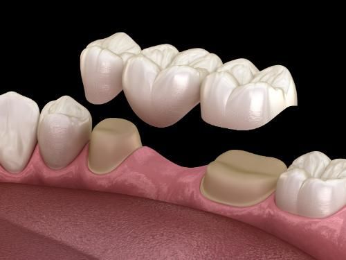 A computer generated image of a dental bridge between two teeth.