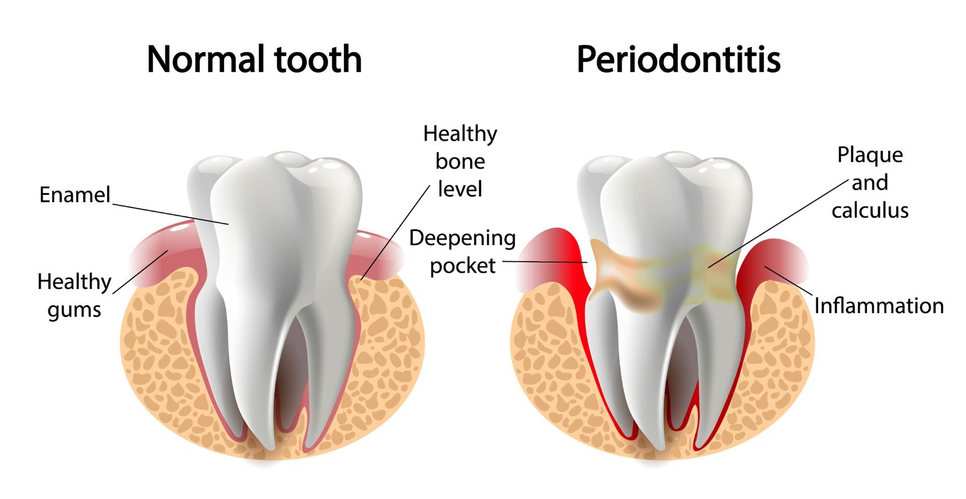 A diagram of a normal tooth and a tooth with peri-implantitis