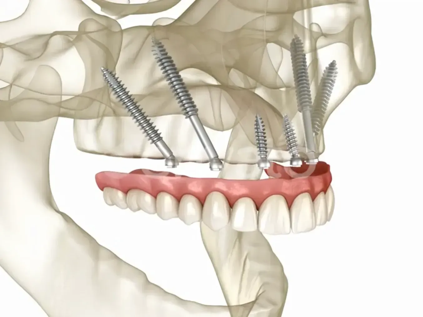 zygomatic dental implants fl