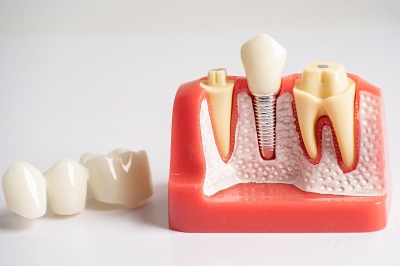 components of a dental implant