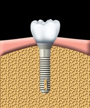 tooth implant graphic model image