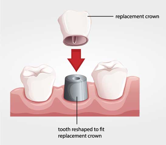 Tooth replacement