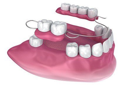 removable partial dentures graphic image