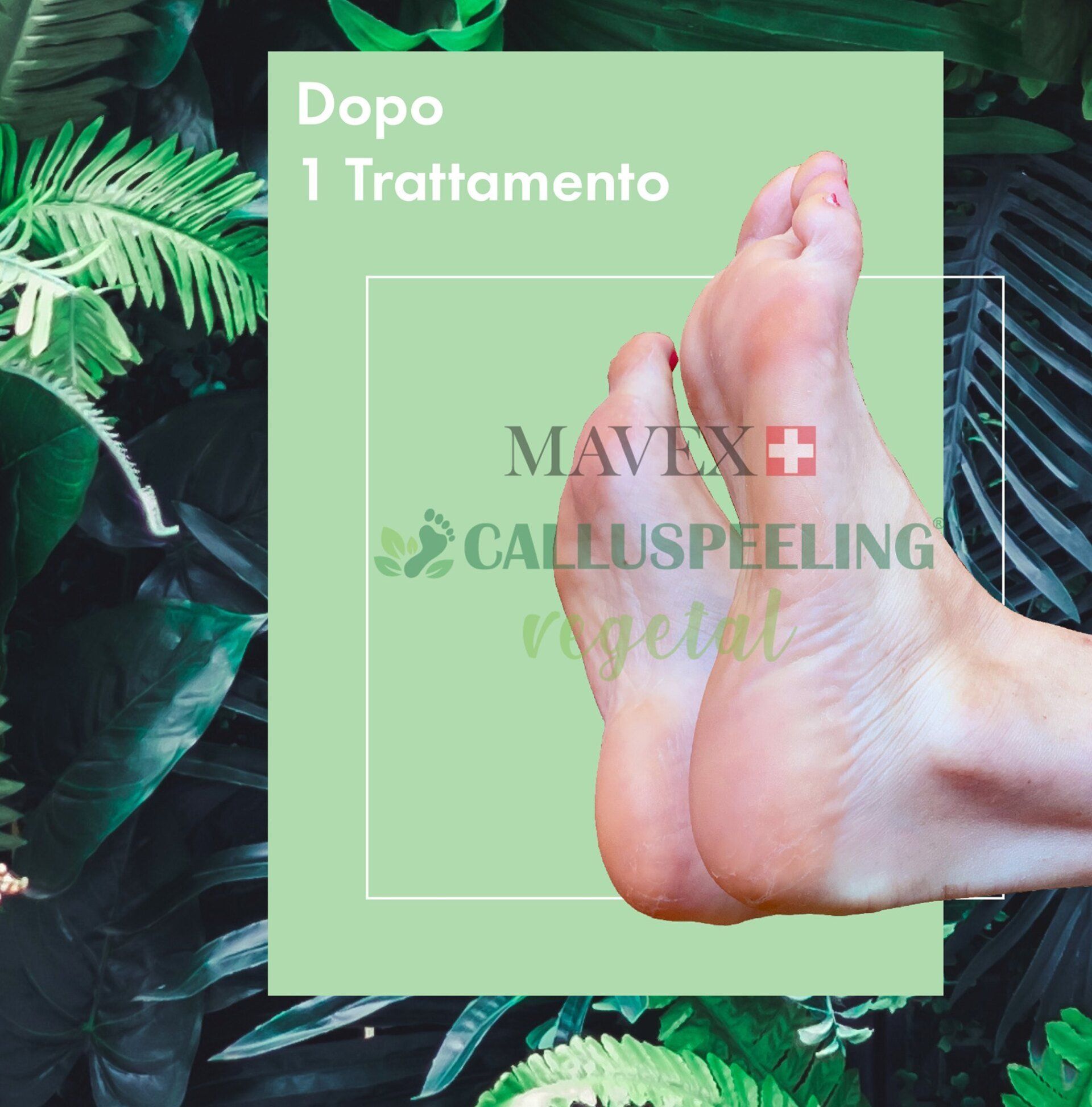 Un'immagine dei piedi di una persona con sopra la scritta mavix calluspeeling