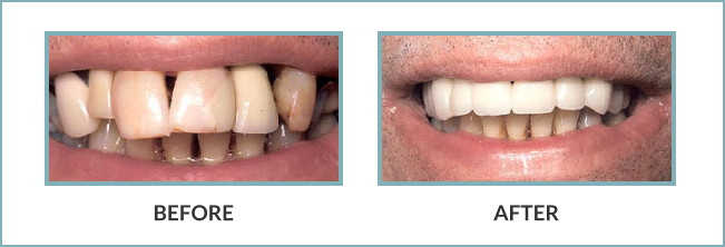 Gentle Touch Family Dentistry - Crowns & Bridge - Before and After