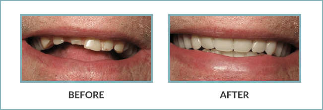 Gentle Touch Family Dentistry - Dentures - Before and After