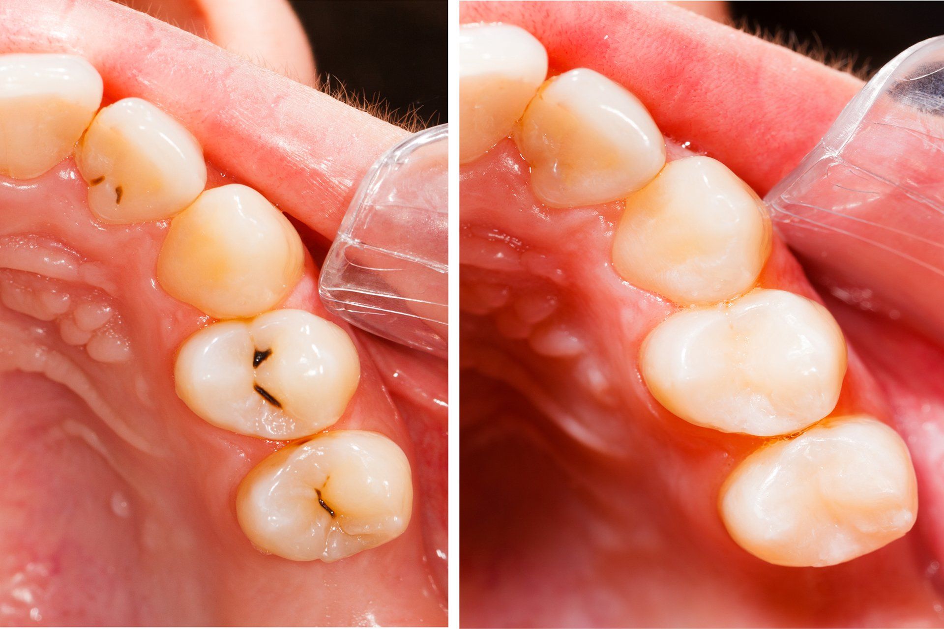 Gentle Touch Family Dentistry - Composite Fillings