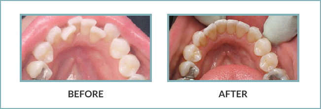 Gentle Touch Family Dentistry - Invisalign - Before and After