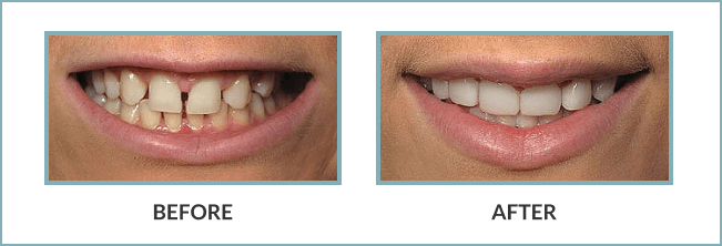 Gentle Touch Family Dentistry - Lumineers - Before and After