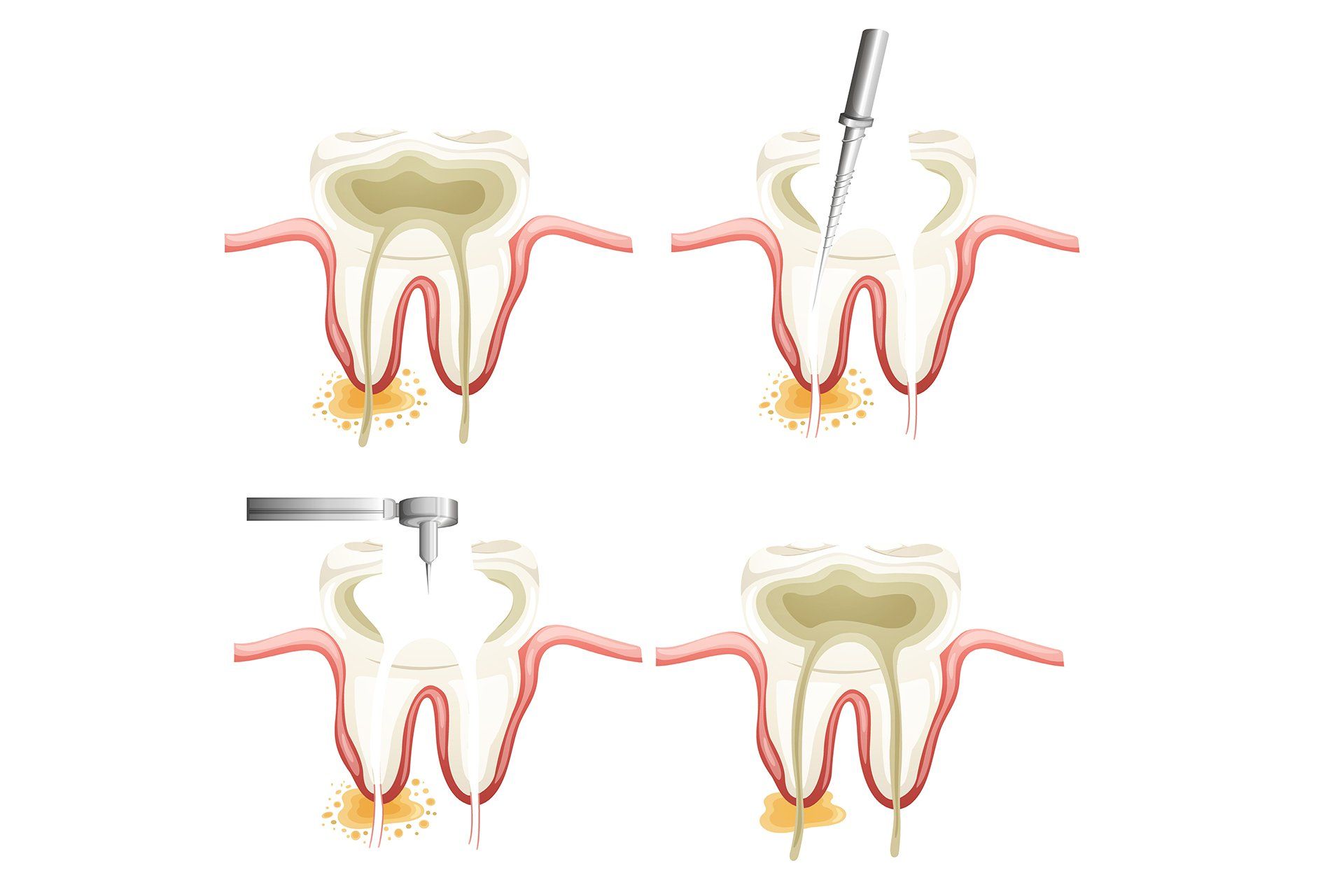 Gentle Touch Family Dentistry - Root Canal Treatment