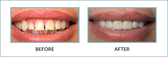 Gentle Touch Family Dentistry - Veneers - Before and After