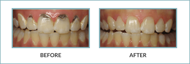 Gentle Touch Family Dentistry - White Fillings - Before and After