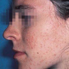 A close up of a woman 's face with freckles.