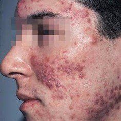 A close up of a man 's face with acne on it.