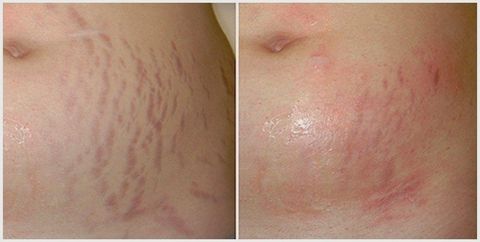 acretin for stretch marks