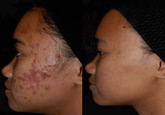 Acne & Acne Scar Treatment at MaxAesthetics MedSpa