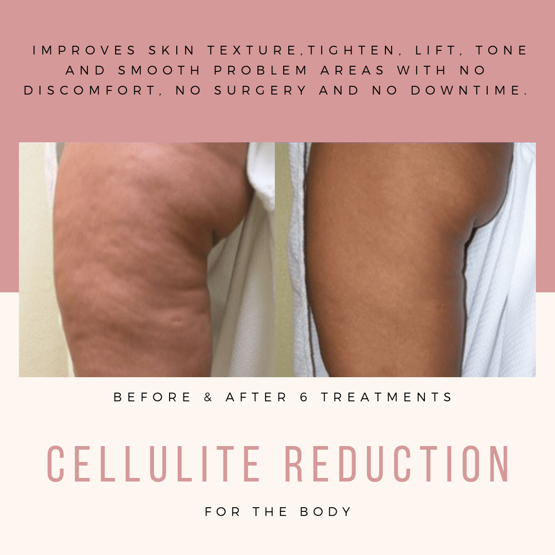 Cellulite reduction treatments