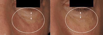 A before and after picture of a person 's face with circles around it.