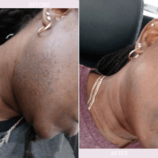 a before and after of laser hair removal of neck and face .