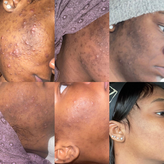 A collage of four pictures of a woman 's face showing different stages of acne before & after acne treatment          