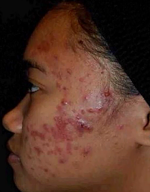 Skin with severe Acne before treatment