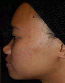 Skin After Acne treatments